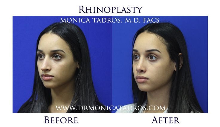 best uk revision rhinoplasty surgeon