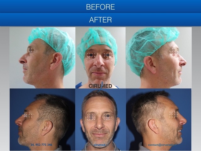 best uk revision rhinoplasty surgeon